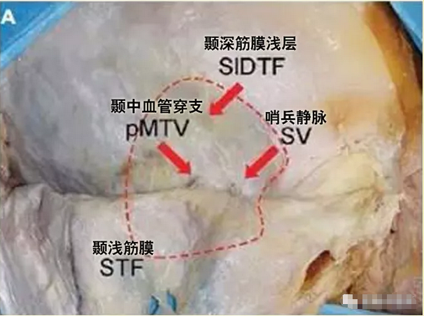 颞部穿行血管展示;颞中血管的穿支和哨兵静脉穿过颞浅筋膜(64岁男性