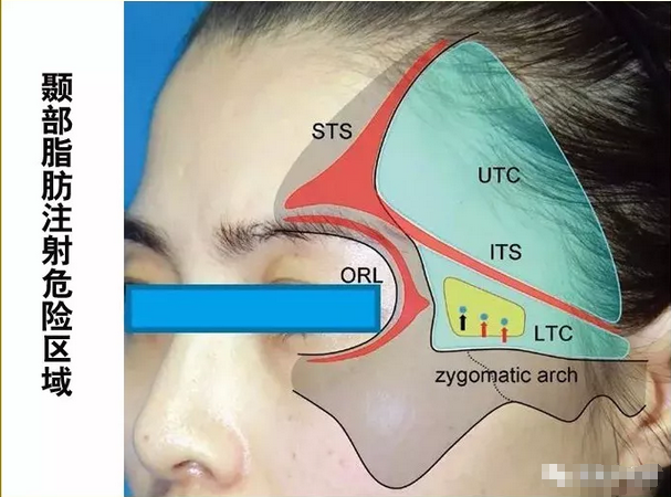 颞部脂肪注射"危险区域"体表投影(37岁女性;该区域为颞下筋膜室前半