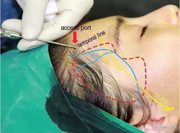推荐的脂肪注射针进针入路为颞线与发际线交界处内侧1cm左右,该部位